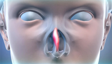 родовая травма носа
